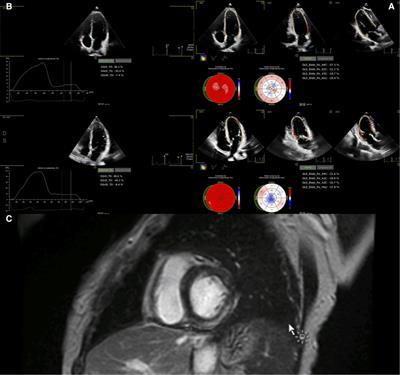 Cardiac manifestations of MIS-C: cardiac magnetic resonance and speckle-tracking data